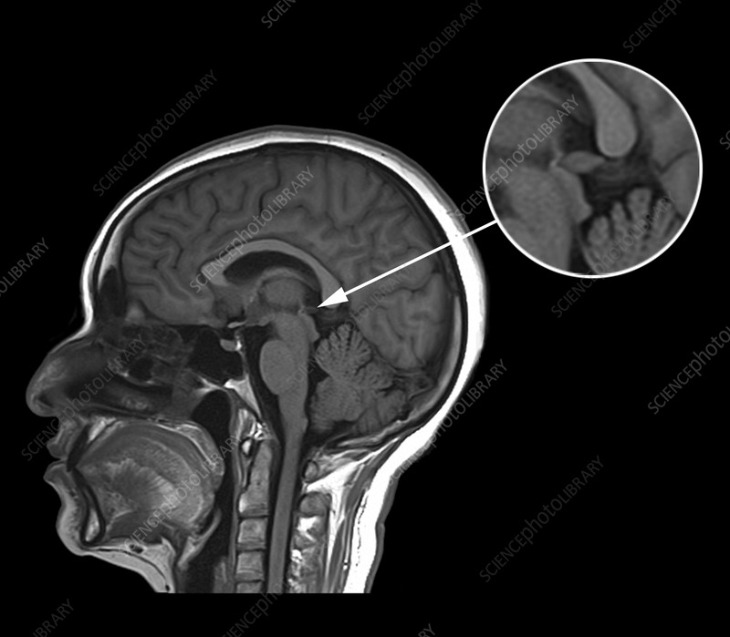 Magnetic resonance imaging (MRI) showing a side view of the brain of a 38-year-old female patient with a healthy pineal gland. The pineal gland is a small endocrine gland located in the epithalamus that secretes the hormone melatonin. Melatonin plays a major role in the regulation of the body's sleep wake cycle. This is a T1-weighted MRI scan.